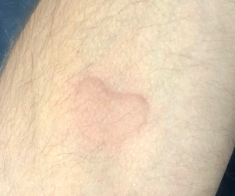 Крапивница: симптомы и лечение